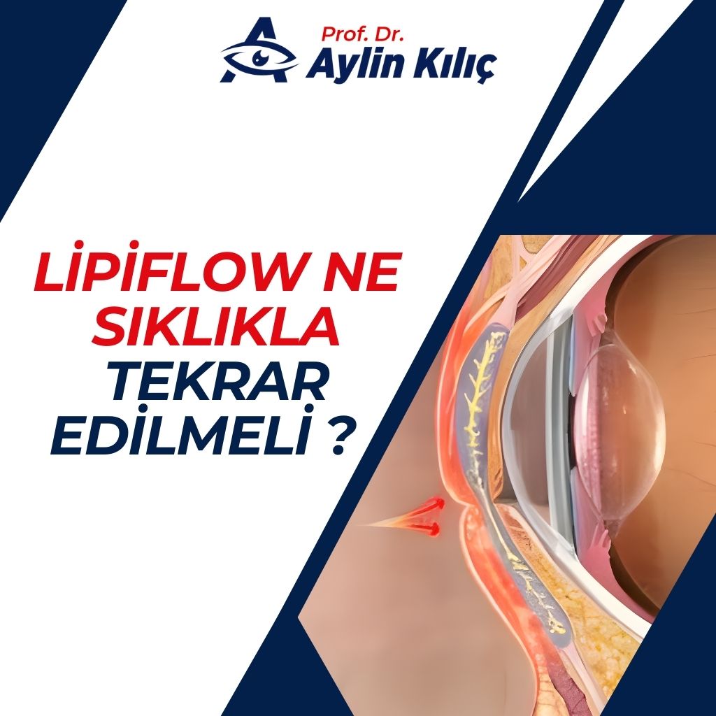 LipiFlow