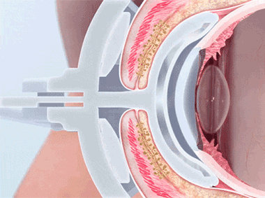 LipiFlow Ne Sıklıkla Yapılmalı? 1 LipiFlow tedavisi