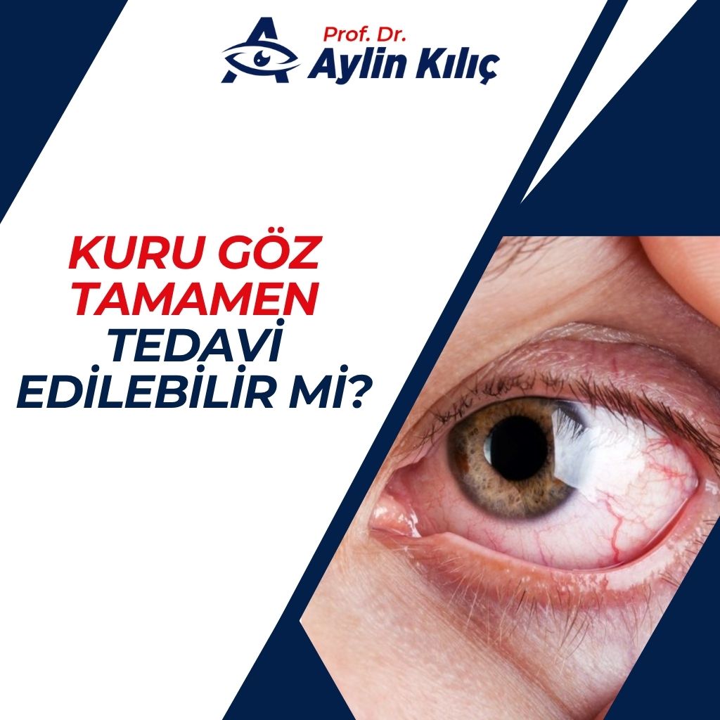 Kuru Göz Tamamen Tedavi Edilebilir mi?