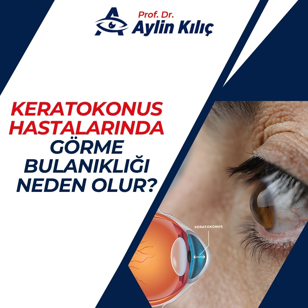 Keratokonuslarda Gorme Bulanikligi Neden Olur