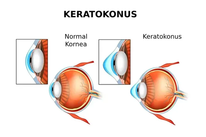 keratokonus-kuru göz