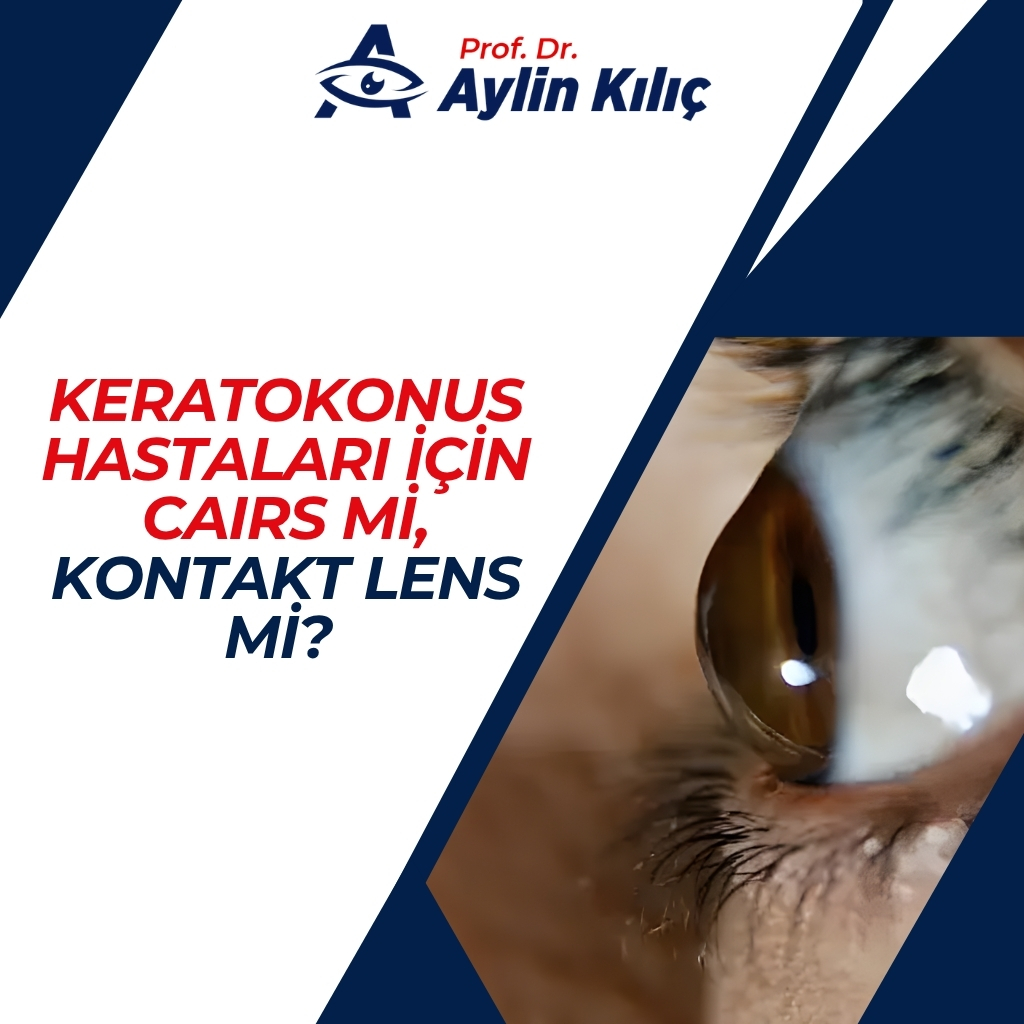 Keratokonus Hastaları için CAIRS mi, Kontakt Lens mi? 3 CAIRS mi, Kontakt Lens mi