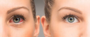 LASIK Sonrası Göz Kuruluğu Ne Kadar Sürer? 2 goz kurulugu 2