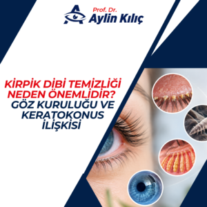 Goz Kurulugu ve Keratokonus Iliskisi