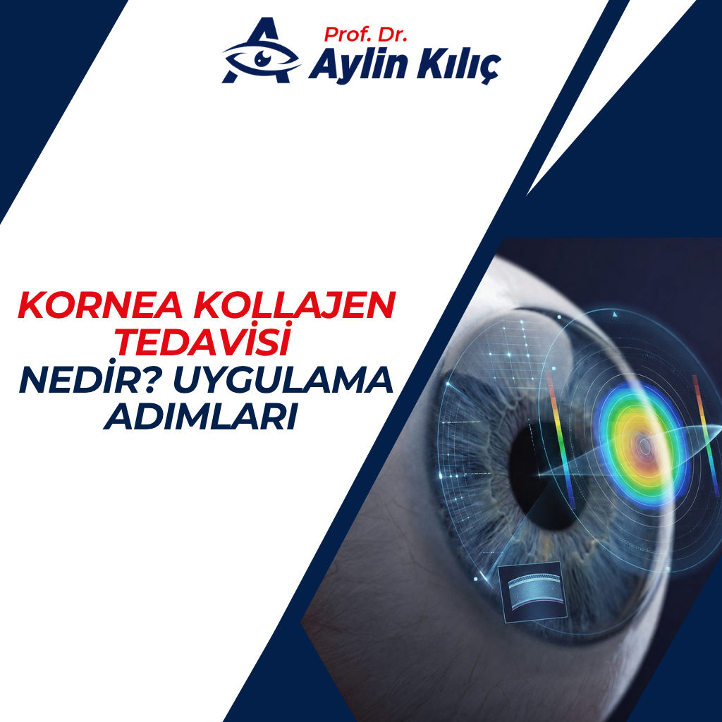 Kornea Kollajen Tedavisi